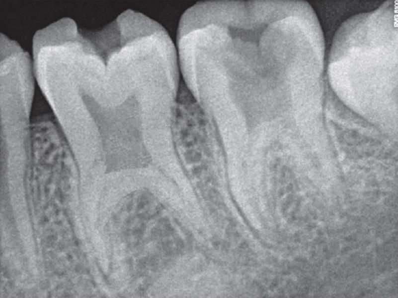 Bull Tooth What is Taurodontism? A Rare Developmental Abnormality.