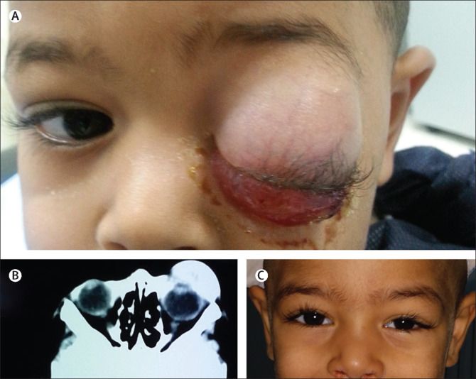 Fewer, tissue cancer, health, Rhabdomyosarcomas, tumor Fewer, tissue cancer, health, Rhabdomyosarcomas, tumor