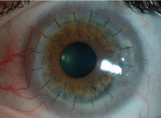 Peters' anomaly, disease, syndrome, eye, Peter's Anomaly: Disease That Cause Corneal Opacity., This is also a one type of the conditions., Peter's plus syndrome Peters' anomaly, disease, syndrome, eye, Peter's Anomaly: Disease That Cause Corneal Opacity., This is also a one type of the conditions., Peter's plus syndrome