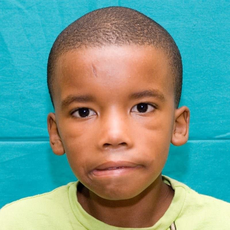 Moebium syndrome, German neurologist, Moebius Syndrome: disorder present in birth congenital., Its exact cause is unknown. Moebium syndrome, German neurologist, Moebius Syndrome: disorder present in birth congenital., Its exact cause is unknown.