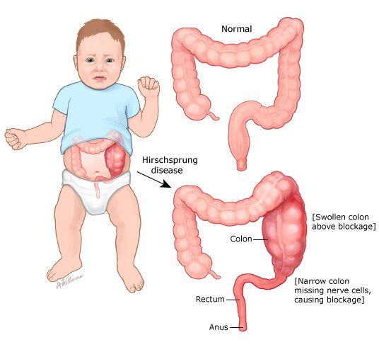 Hirschsprung disease, born baby, disease Hirschsprung disease, born baby, disease