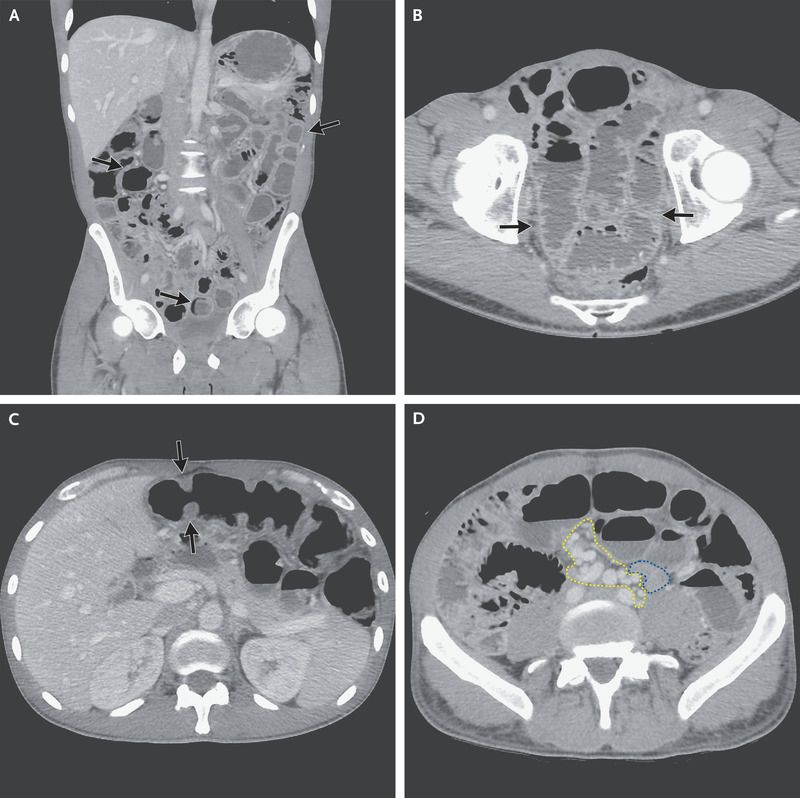 Journal Case, Clear Cell Sarcoma, immunohistochemical, abdominal distention Journal Case, Clear Cell Sarcoma, immunohistochemical, abdominal distention