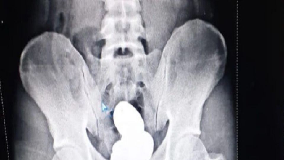 Gold Meriting , Mohammed Sharif , Stomach, Kozhikode,  Kerala,  X-ray