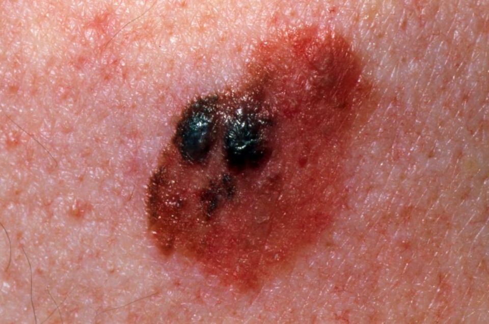 malignant melanoma, skin changes, Doctor, skin cancer, body