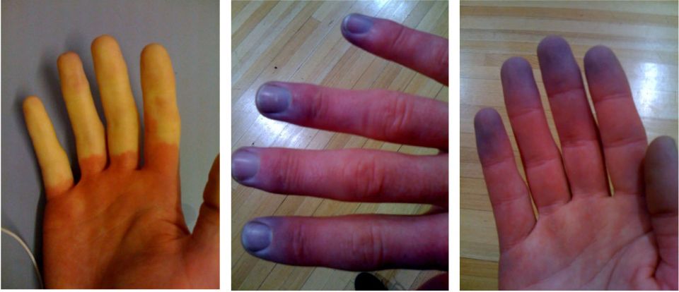 Raynaud syndrome, Raynaud's Phenomenon, disease, gangrene and skin sores, manoeuvres