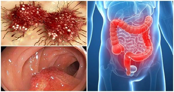 Anal cancer, disease, medical, health, treatment Anal cancer, disease, medical, health, treatment