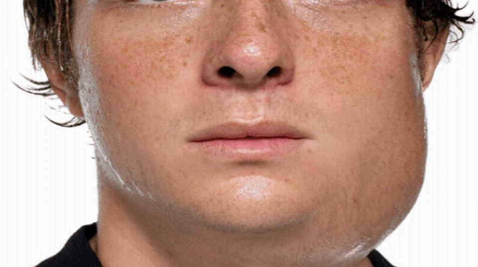 Mumps Virus, Testicles , saliva-producing glands, salivary, epidemic parotitis Mumps Virus, Testicles , saliva-producing glands, salivary, epidemic parotitis