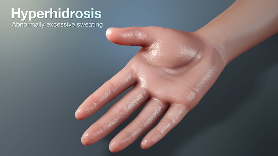 Hyperhidrosis, psychological, emotional, social perspective, diabetes, anxiety, thyroid, blood pressure Hyperhidrosis, psychological, emotional, social perspective, diabetes, anxiety, thyroid, blood pressure
