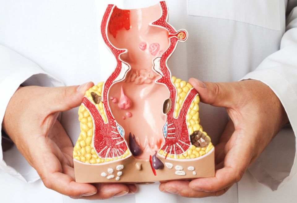 Anal cancer, disease, medical, health, treatment Anal cancer, disease, medical, health, treatment