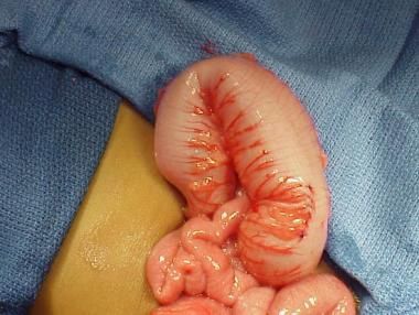 Hirschsprung disease, born baby, disease Hirschsprung disease, born baby, disease