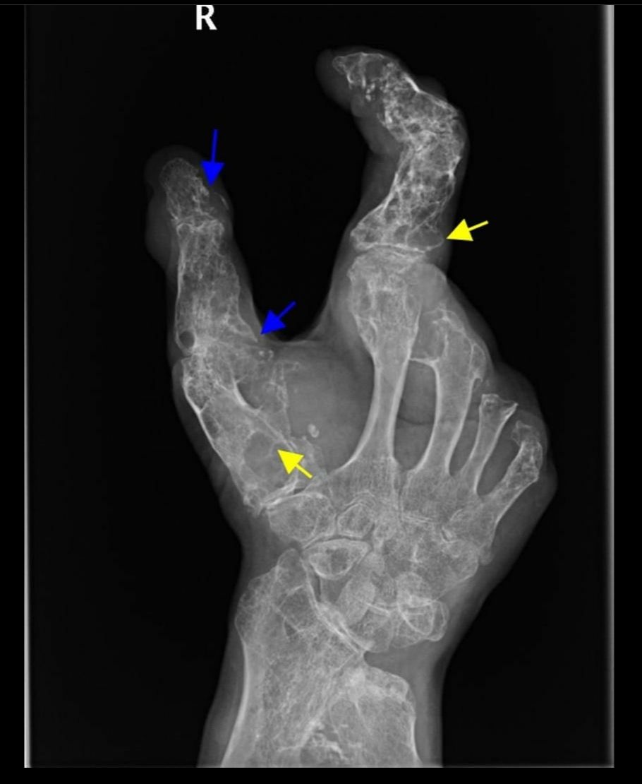 Ollier Disease, RSNA, disease Ollier Disease, RSNA, disease