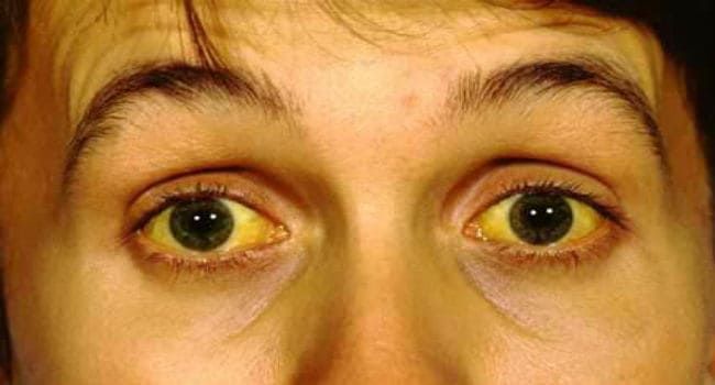 Fever, Yellow fever, health, huhman, disease Fever, Yellow fever, health, huhman, disease