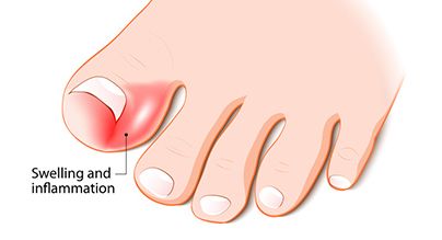 Ingrown Toenail, condition, toenail, nail, ingrown nail Ingrown Toenail, condition, toenail, nail, ingrown nail