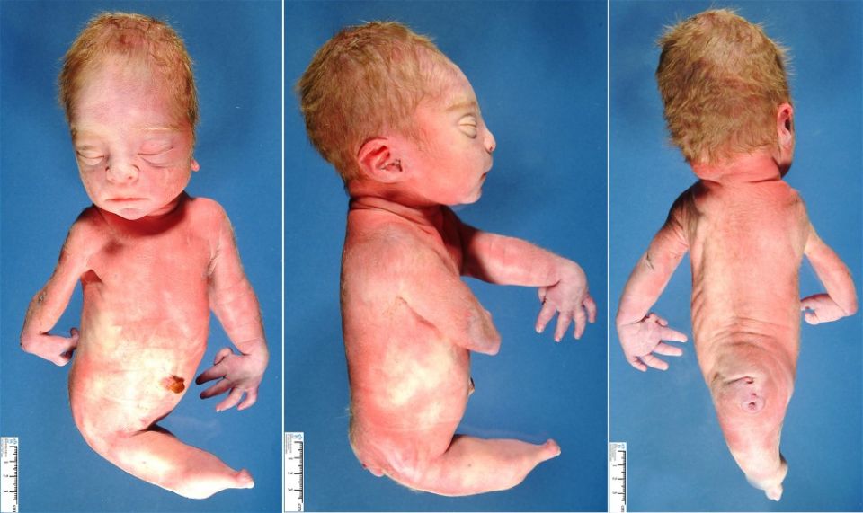 Sirenomelia, Mermaid Syndrome, kidney specialists, kids, infants, kidney