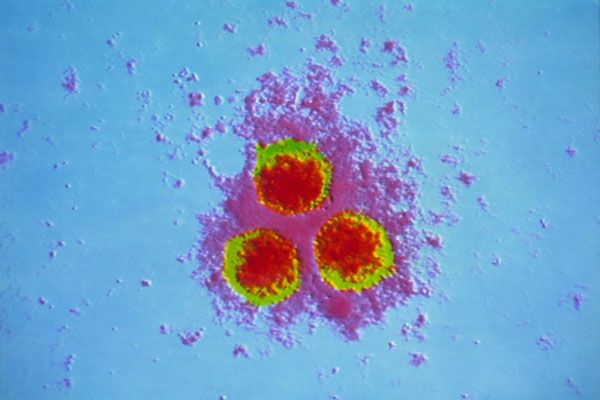 varicella-zoster virus (VZV), Virus, Health, pregnant women, vaccinum, chickenpox