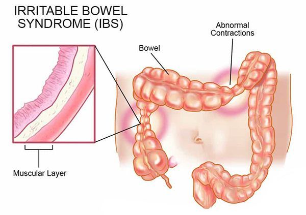 Irritable Bowel Syndrome, Exercise Dietary fibre or fibre supplements Over the counter and prescription drugs Reducing stress or changing behaviours, Irritable Bowel Syndrome: Is The Usual Cause Of Stomach Pain,  Cramping,  And Changed.