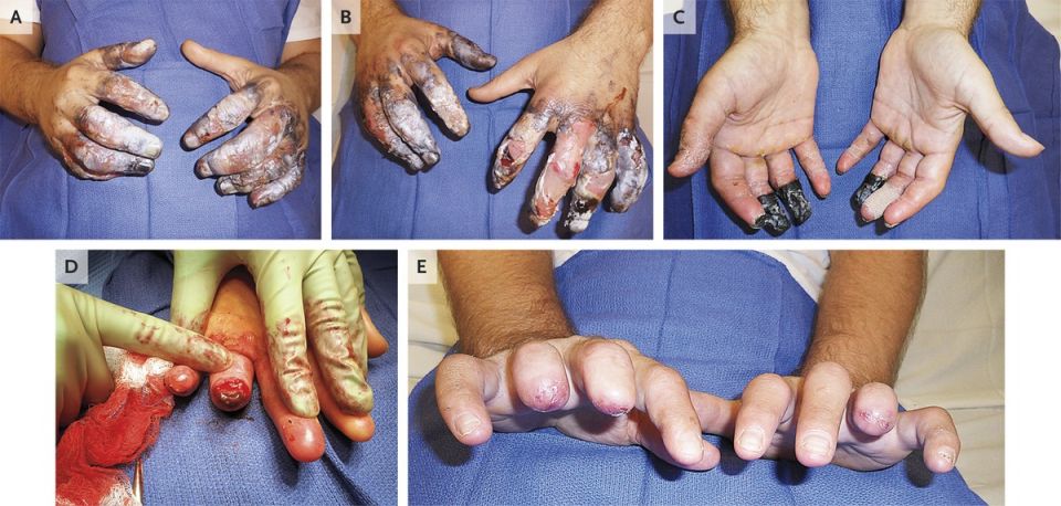 Frostbite, feet, hands, mount everest