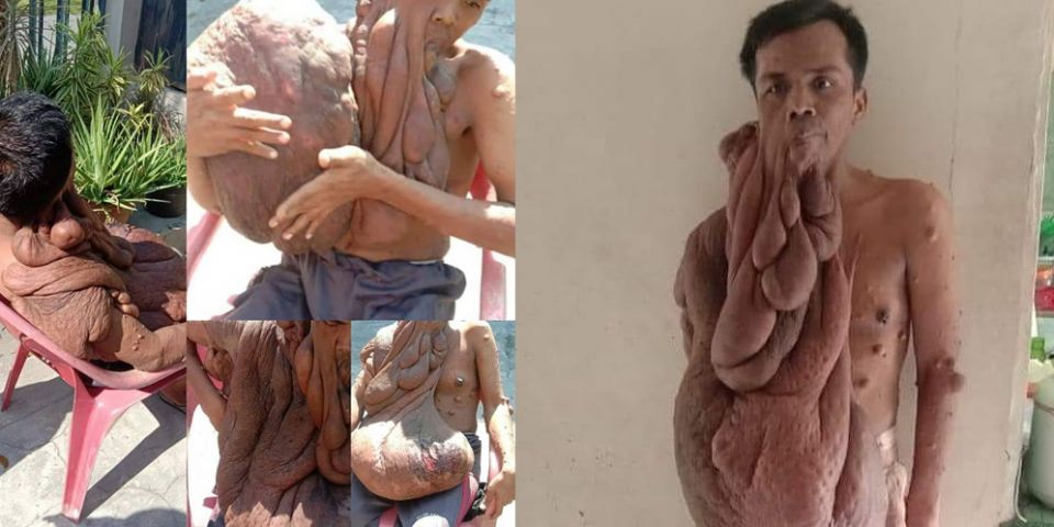 disease, tumor, medical, Neurofibromatosis, blood donations, Andriadi Putra, nerve tissue