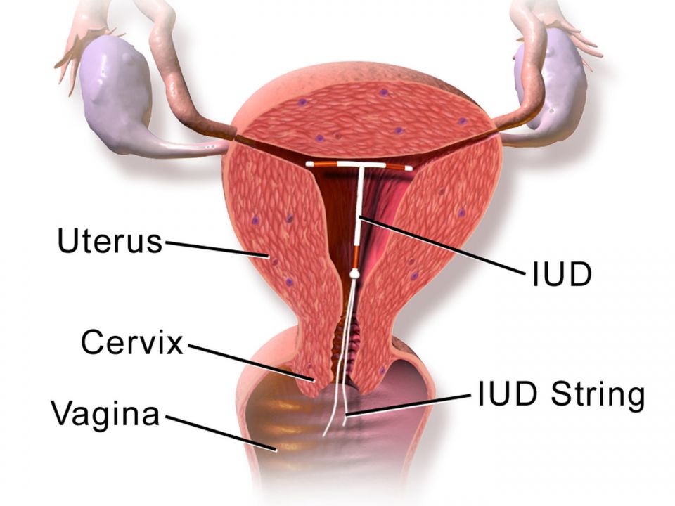 IUDs, T-shaped , coil, human, contaceptives, sex, male, female IUDs, T-shaped , coil, human, contaceptives, sex, male, female