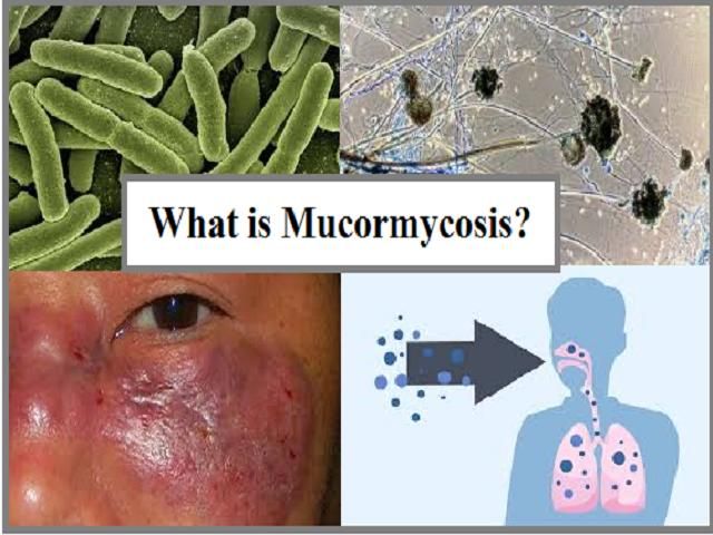 Akshay Nair, diabetic, mucormycosis, covid-19, fungus
