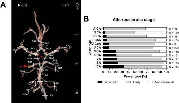 atherosclerosis, rare specimen, brain, ischemic stroke atherosclerosis, rare specimen, brain, ischemic stroke