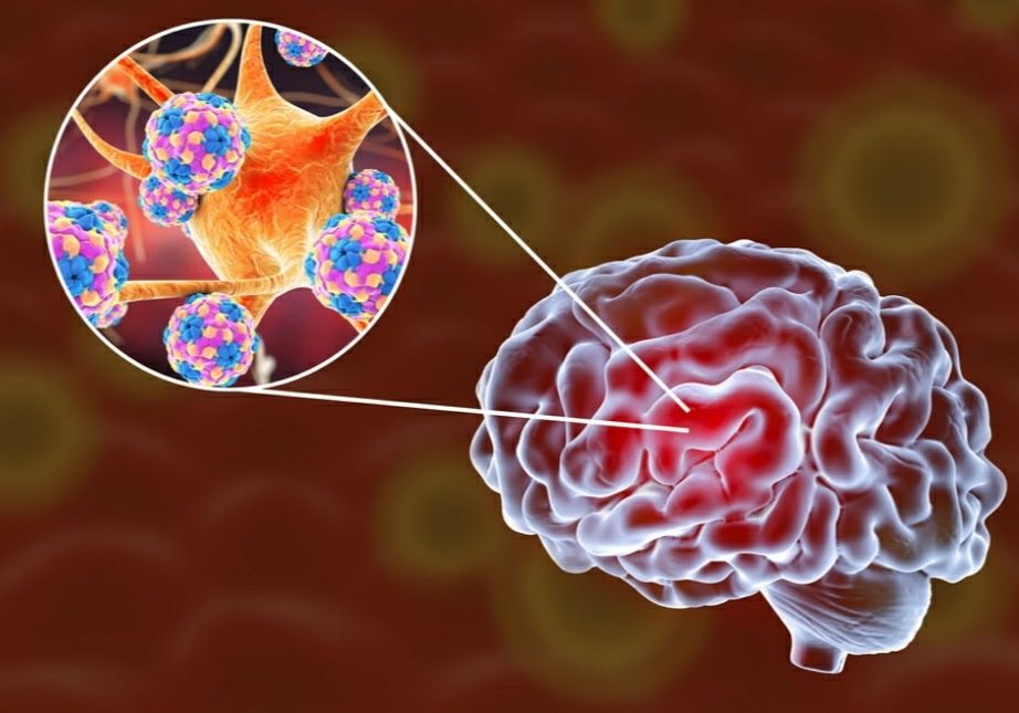 Encephalitis, post-infectious, brain, Acute encephalitis, Chamki Fever in Hindi