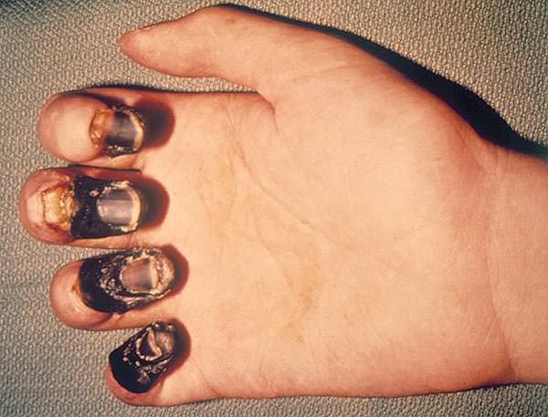 plague , WHO, American state, Dr. metropolis Williams, California plague , WHO, American state, Dr. metropolis Williams, California