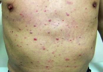 Acute myeloid leukemia, Blood cancer cell, FLT3, Quizartonib , leukaemia patients, Acute myeloid leukaemia, AML patients, blood cancer cell