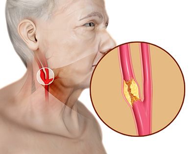 carotid stenosis disease, blood clots, plaque carotid stenosis disease, blood clots, plaque