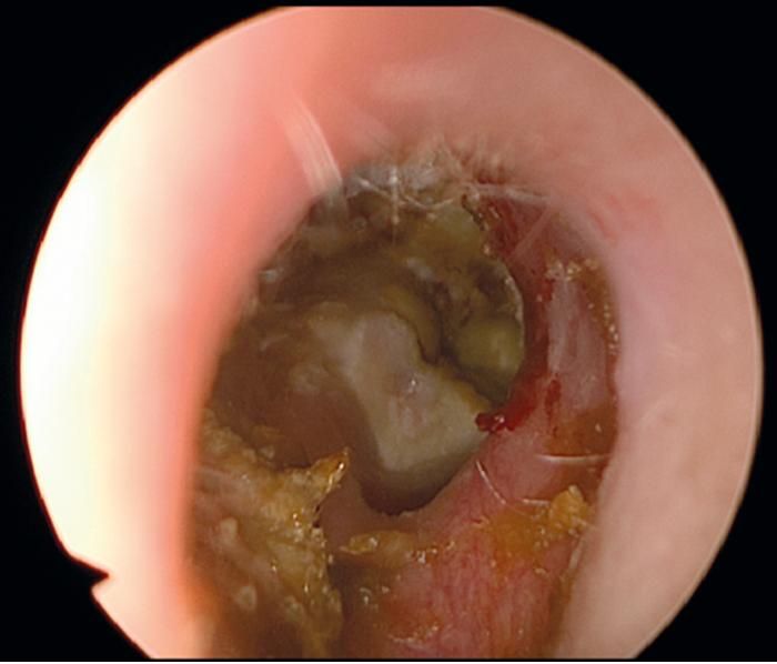 morbid history, herpes zoster, banasogenial sulcus
