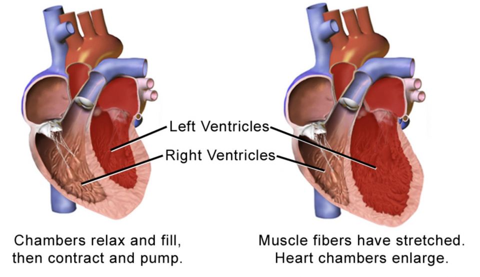 heart attack, Broken Heart, Broken Heart Syndrome Is Unique That Is Most Seen In Women., Their heart usually resolves to normal function so it's a really unique disease.