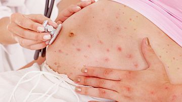 varicella-zoster virus (VZV), Virus, Health, pregnant women, vaccinum, chickenpox