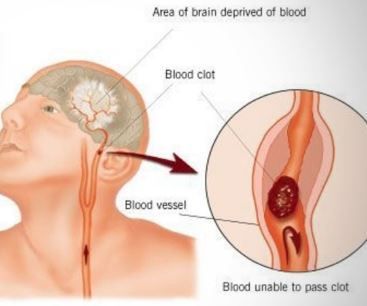 Paralysis, human body, human