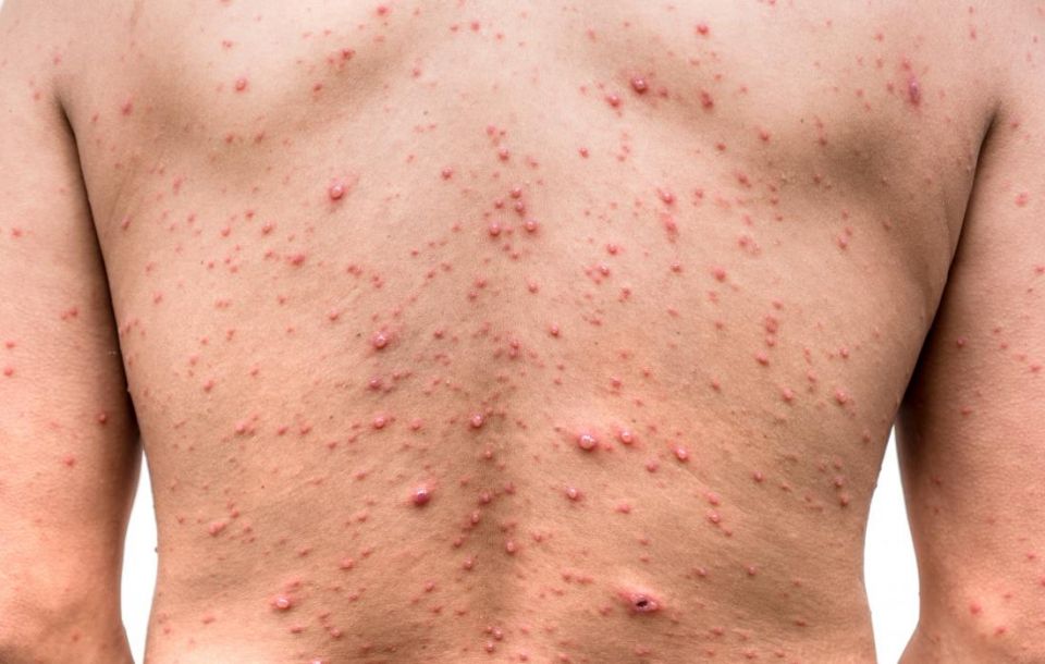 Chickenpox, health, people, Varicella-zoster virus (VZV), disease