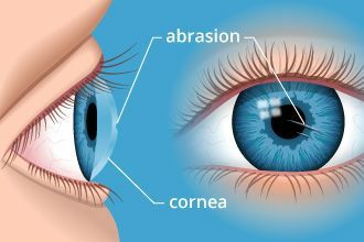 corneal abrasion, optometrist, teardrops corneal abrasion, optometrist, teardrops