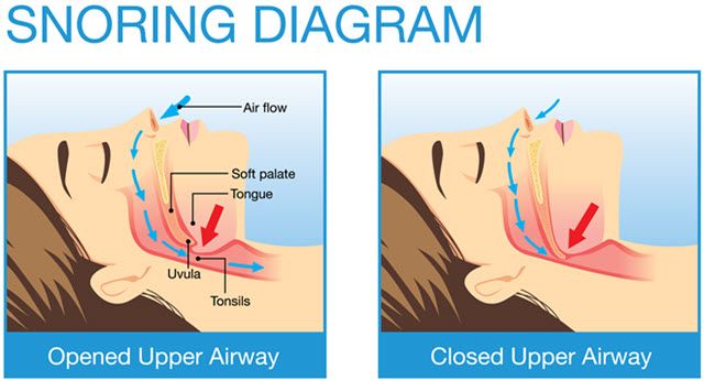 sleep apnea, snoring, pharynx, people snoring, snoring while sleeping, diabetes, arrhythmias, irregular heartbeats, heart disease, untreated obstructive sleep sleep apnea, snoring, pharynx, people snoring, snoring while sleeping, diabetes, arrhythmias, irregular heartbeats, heart disease, untreated obstructive sleep