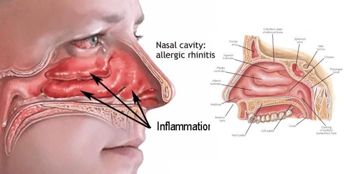 Britain, hypersensitivity, health, human, allergic rhinitis