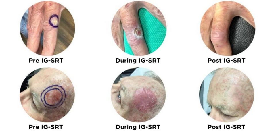 cancer, SSC, Squamous cell carcinoma, UV light, SSC Cancer