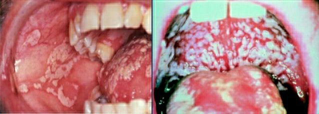 Agranulocytosis, neutropenia Agranulocytosis, neutropenia