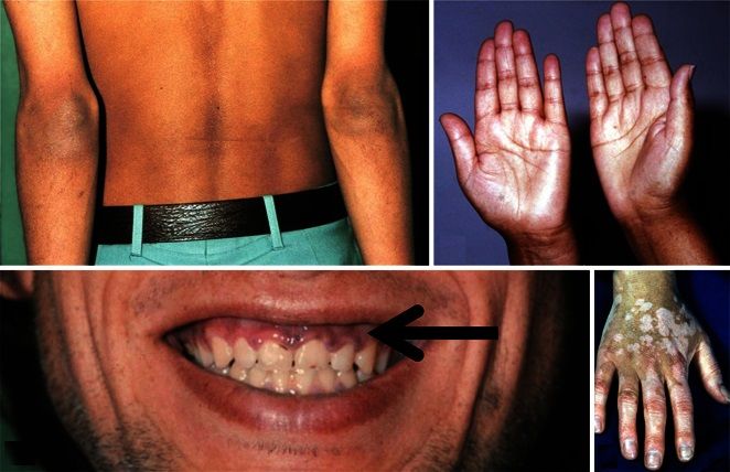 glandular disease, treatment,  Addison&rsquo;s unwellness, primary adrenal insufficiency , hypoadrenalism