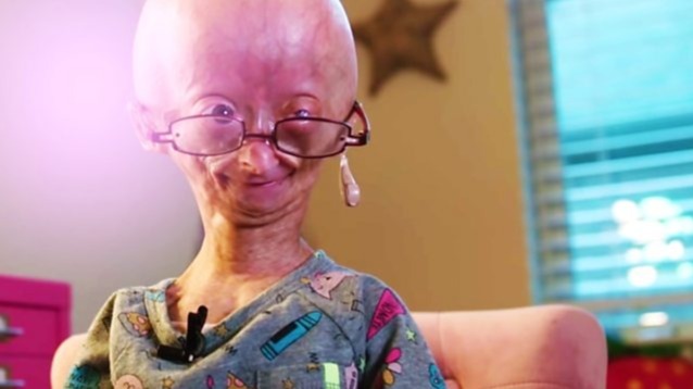 mother daughter relation, disease, Adalia, Progeria