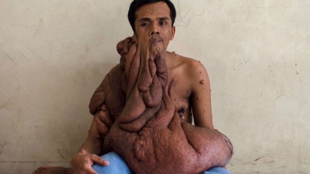 disease, tumor, medical, Neurofibromatosis, blood donations, Andriadi Putra, nerve tissue