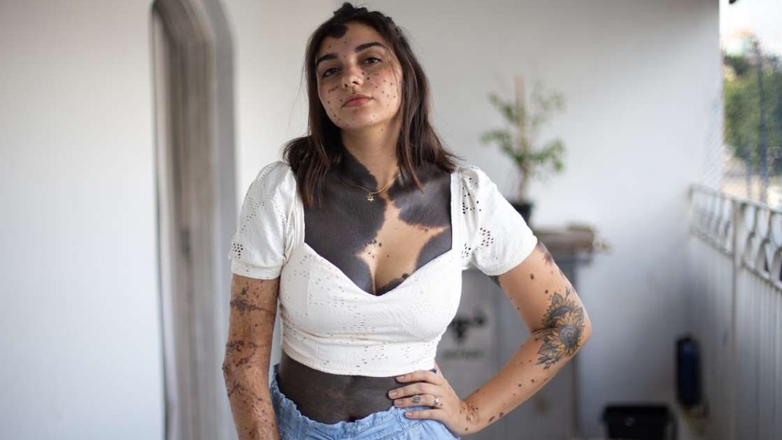 birthmarks, ain't congenital melanocytic nevus, Beatriz Pugliese, brazil, Beatriz Pugliese birthmarks, Beatriz Pugliese marks, Beatriz Pugliese skin, Beatriz Pugliese age, Beatriz Pugliese hot