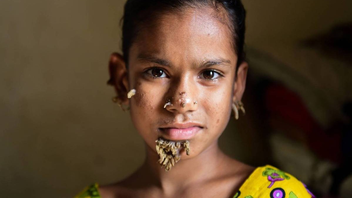 Tree Man Disease First Female With Rare Skin Syndrome Tree Man Disease First Female With Rare Skin Syndrome
