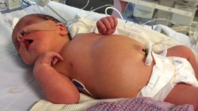 Hirschsprung disease, born baby, disease