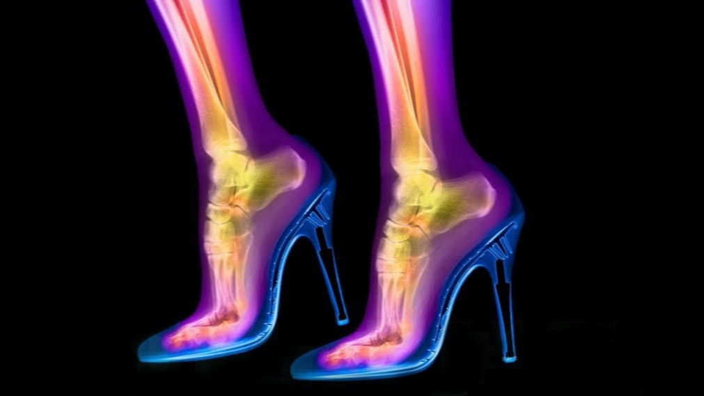 Metatarsalgia, high heels, feet, pain, heels, fashion
