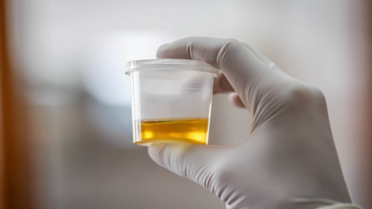 Urine Routine Test Detect STIs, Urine Routine Test, Test Detect