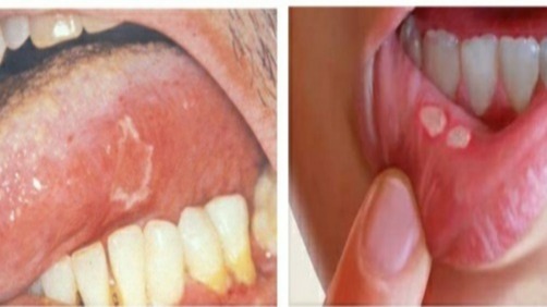 Agranulocytosis, neutropenia