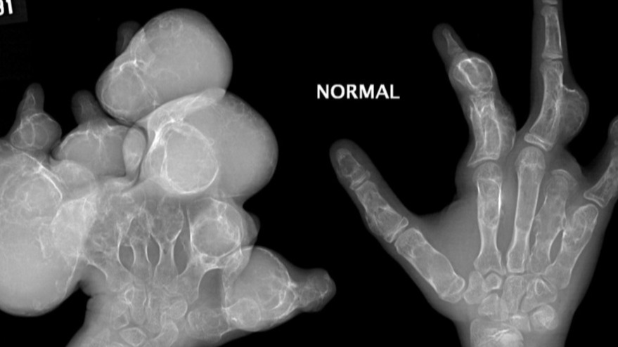 Ollier Disease, RSNA, disease