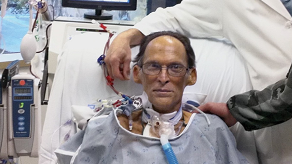 Hearbeat, Man, Dr Billy Cohn and Dr Bud Frazier, Mr Lewis's heart,  Texas heart institute